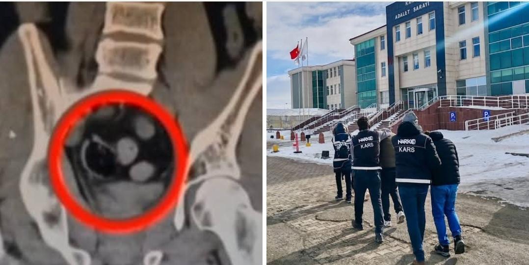 Kars'ta İranlı 3 kişinin bağırsağında uyuşturucu ele geçirildi