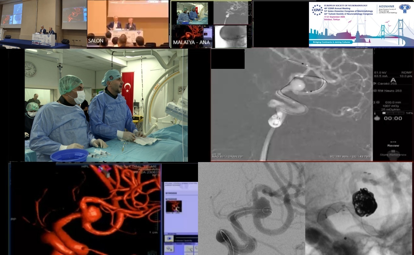 Malatya’dan dünyaya tıbbi başarı: Beyin baloncuğu tedavisi canlı yayında yapıldı