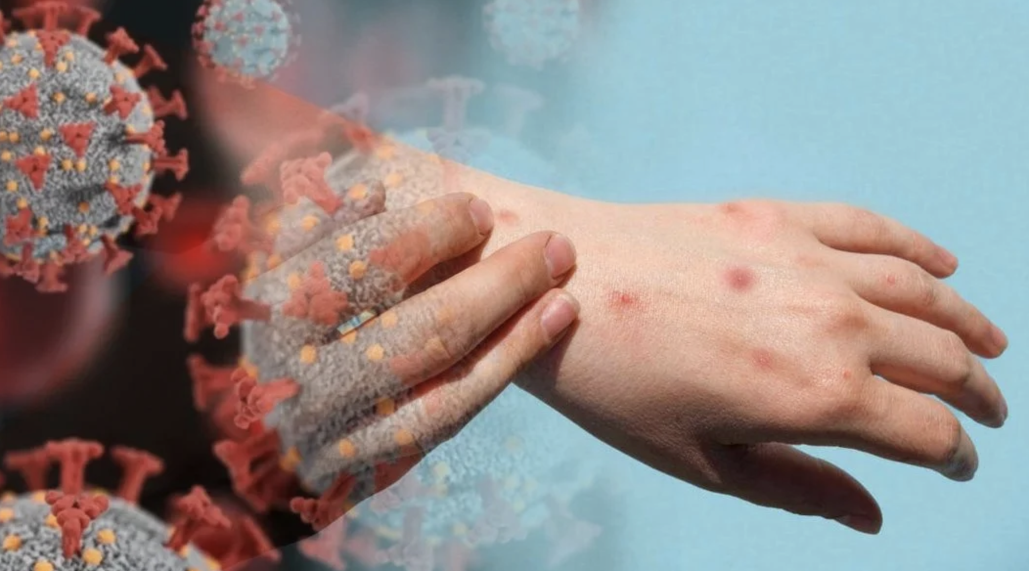 Sağlık Bakanlığı'ndan Mpox (Maymun Çiçeği) virüsü için 2024 rehberi