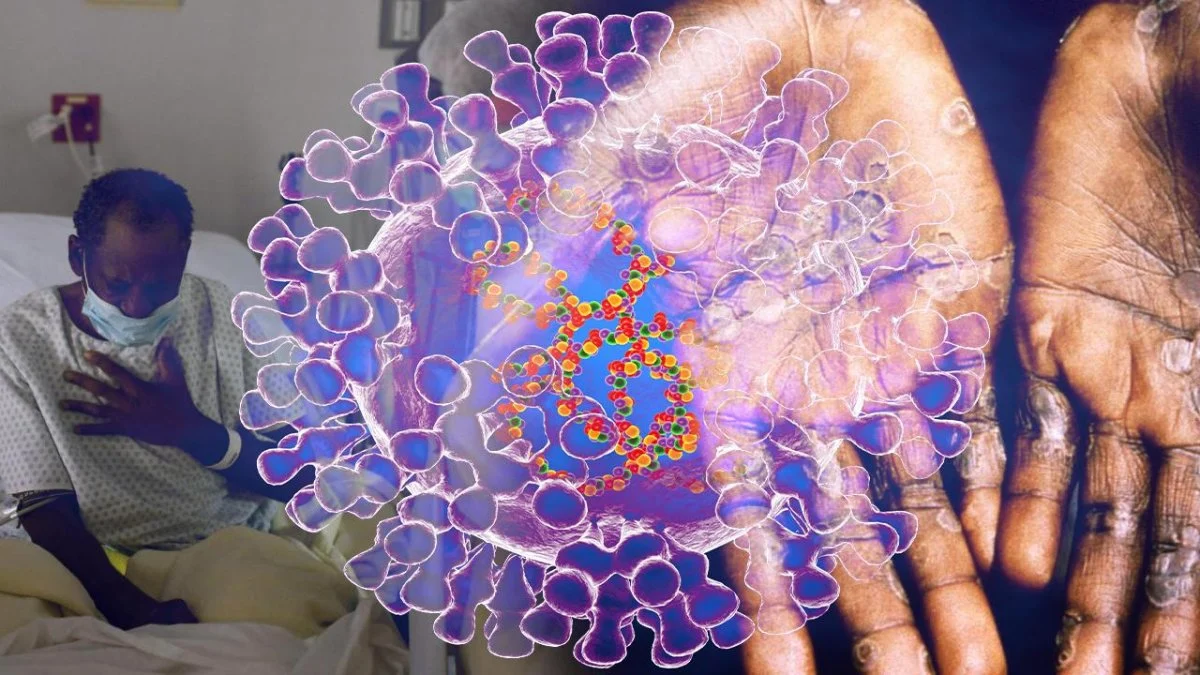 Maymun Çiçeği virüsü Avrupa'da görüldü!