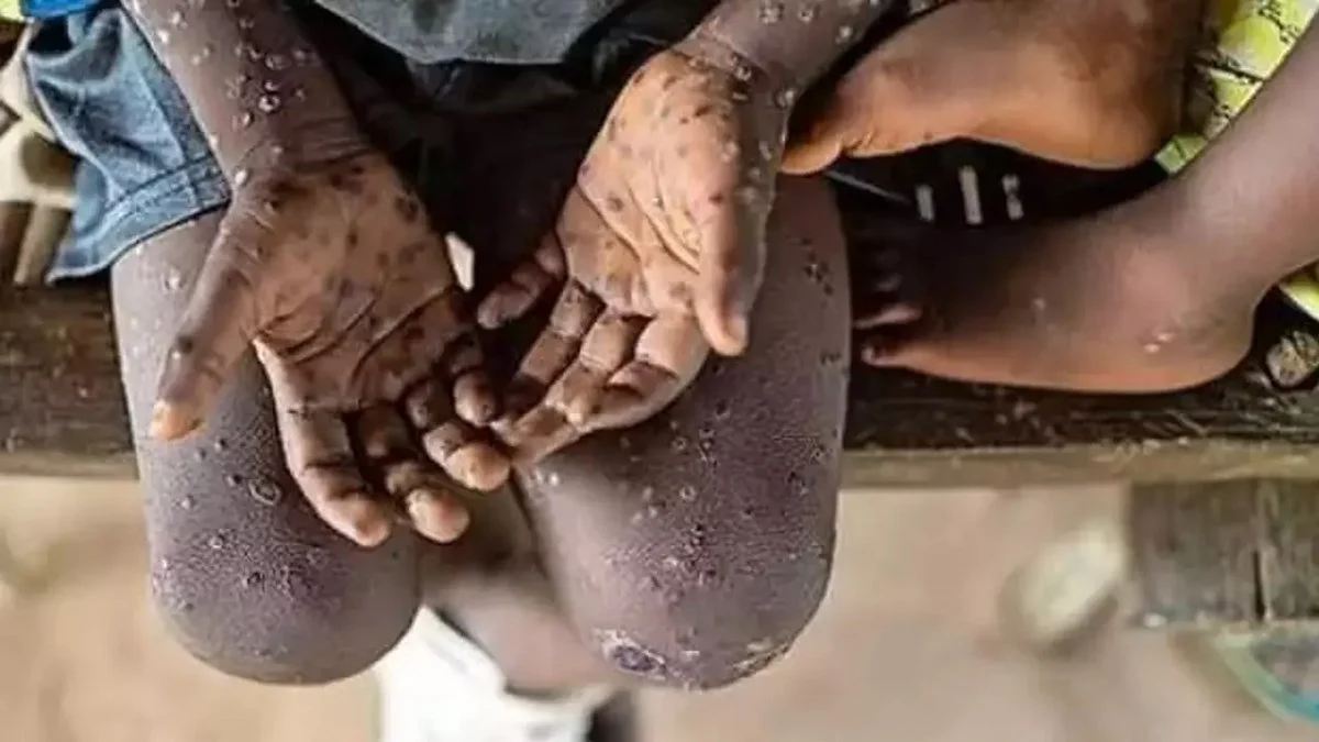 Maymun Çiçeği Afrika'da endişelendiriyor